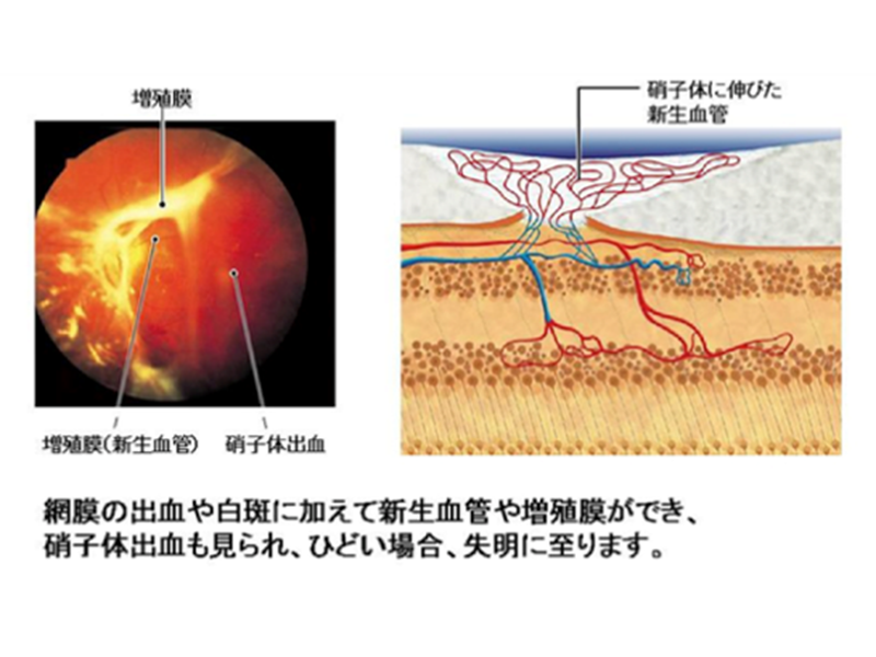 知っているようで知らない新しい糖尿病網膜症診療 知っているようで知らない 新しい糖尿病網膜症診療 | 神陵文庫