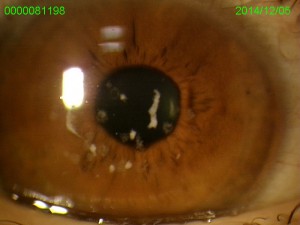 PTK手術前の眼