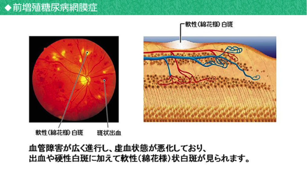 糖尿病2