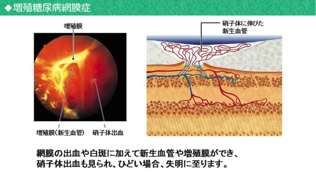 糖尿病3